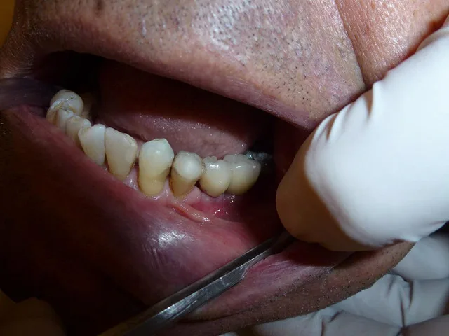 Czy bezpiecznie jest palić po ekstrakcji zęba?