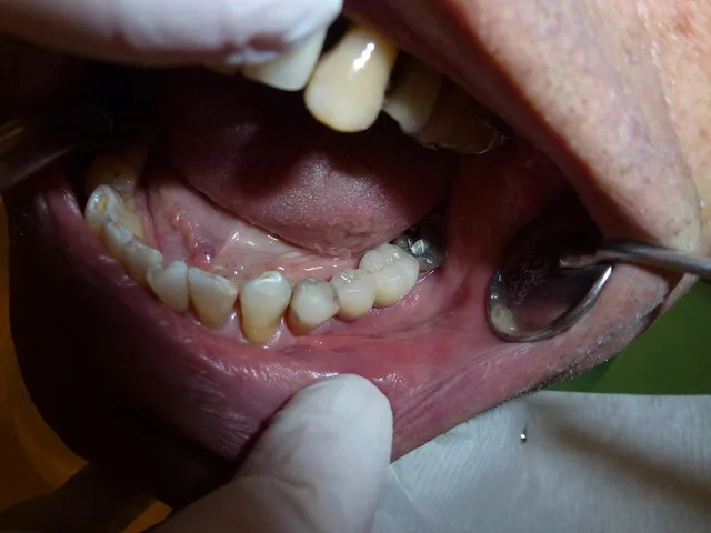 Kiedy należy usunąć korzeń zęba?